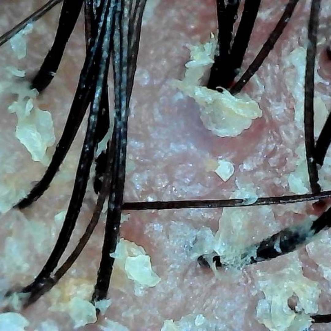 Image showing symptoms of flaky and itchy scalp before treatment.